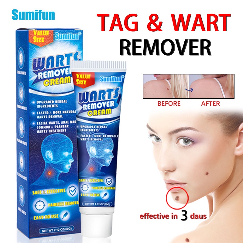 Warts Remover Cream Original Warts And Skin Tags Remover Painless ...