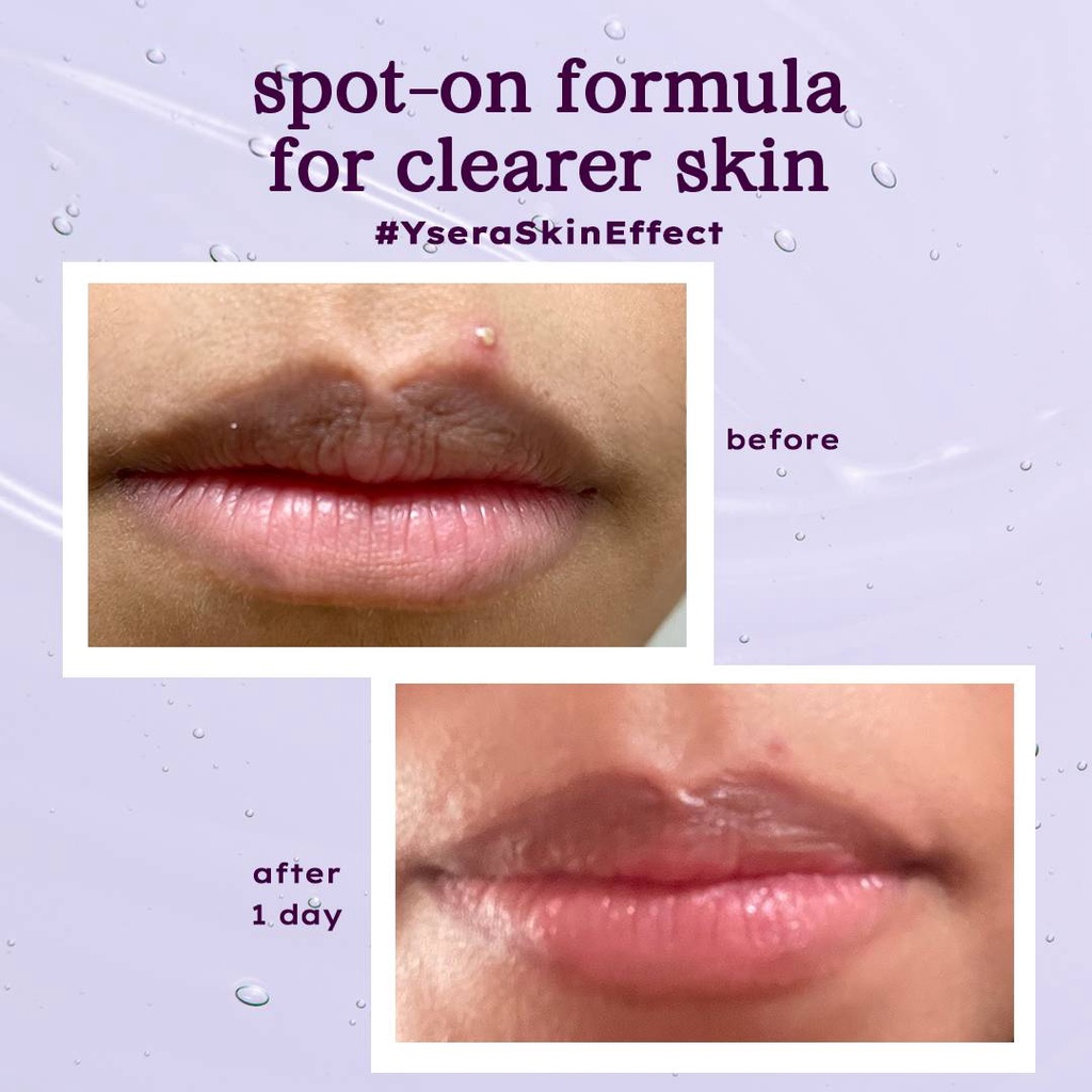 YSERA SKIN Salicylic Spot Gel (For Acne-Prone)