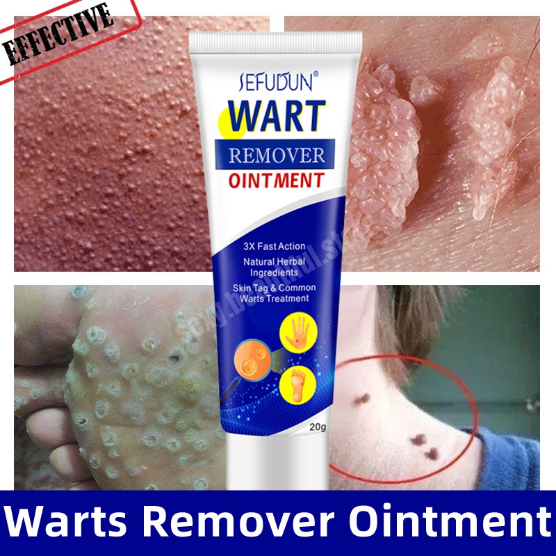 Warts Remover Cream Foot Corns Remover Cream Warts Removal Ointment To