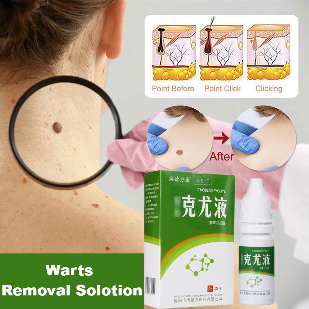 10ml Effective Warts Remover Liquid Remove Mole Skin Tags Get Rid Of Neck Warts Kulugo Wart