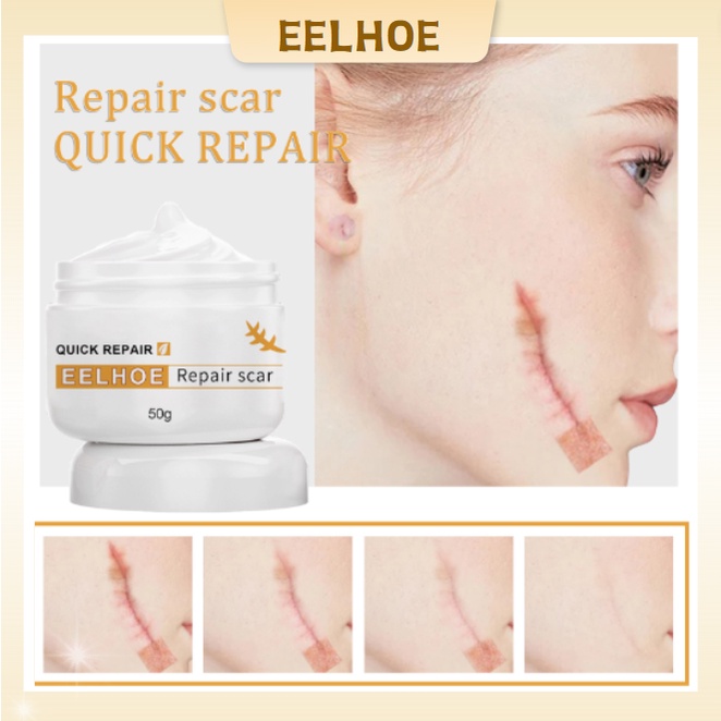 EELHOE scar removal cream scar remover old scar acne scar removal for legs Peklat removal cream