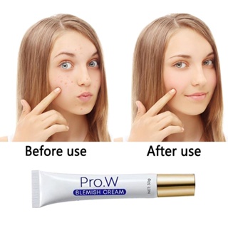 ▲⊙1 Pcs NEW Blemish Cream Freckles Acne Pimple Spots Removal Treatment Pimple Ointment Scar Mark  A #1