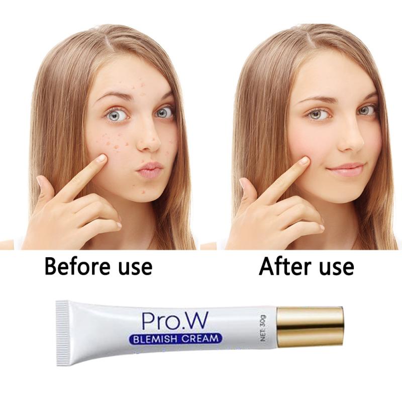 30g Blemish Cream Spots Removal Treatment Pimple Ointment Scar Anti Acne Cream Acne Skin Care White