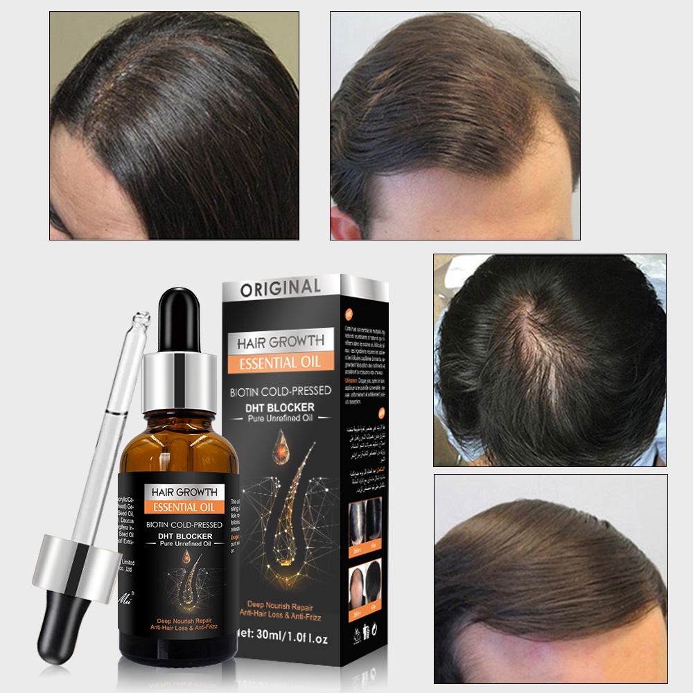 Hair Growth Anti-Loss Hair Care Serum Ginger Hair Care Oil Hair Loss Growth  Increase Hair Density 30ml Improve Hair Follicles Nourish Hair Roots Hair  Oil For Men Women Soothe | Men's Hair
