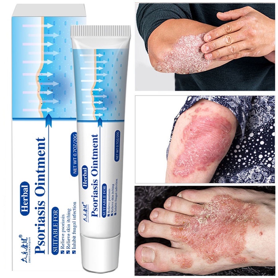 Antibacterial Psoriasis Cream Herbal Treatment Eczema Relief Itch Rash