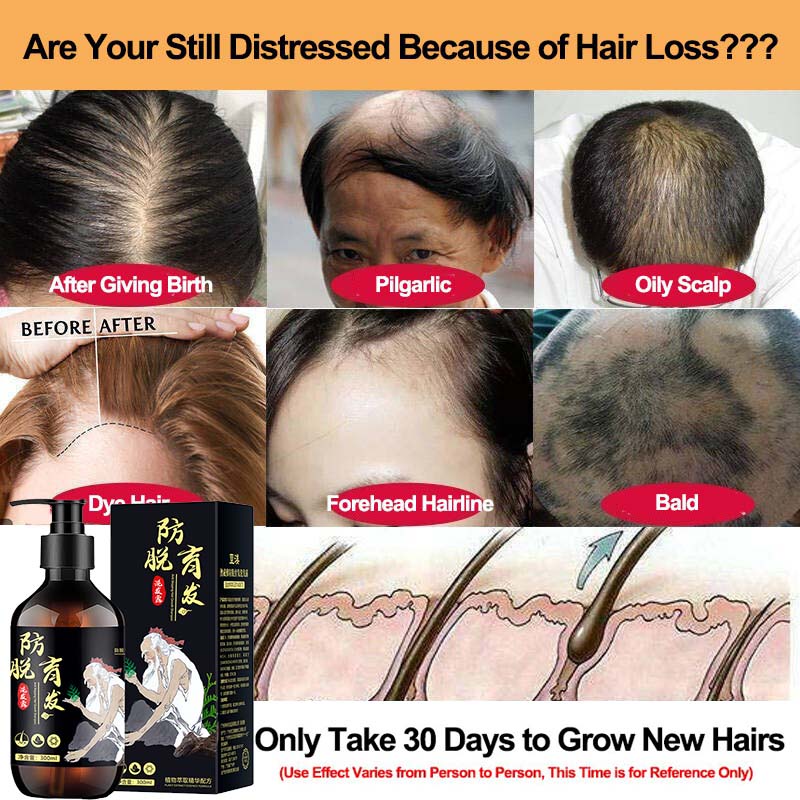 Hair Growth Shampoo Promote Hair Growth Oil Control Repairs Damaged Scalp Anti Hair Loss Shampoo kkm