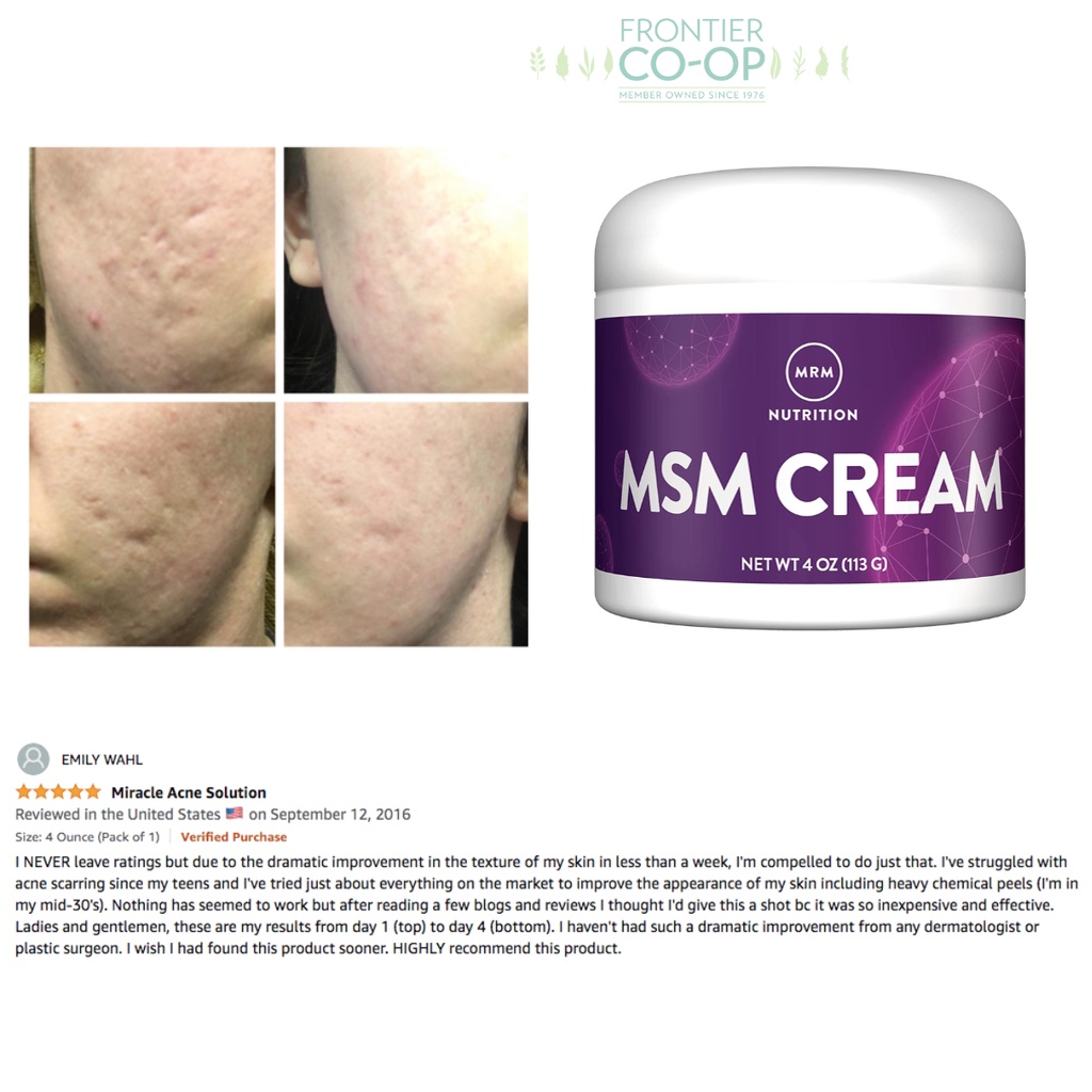 Msm Cream Mrm Indented Pitted Face Body Scars, Facial Moisturizer | Shopee  Philippines