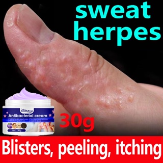 Eczema Cream Effective Itching Sweat Herpes Treatment Ointment for Itchy Skin Mosquito Bite Ointment