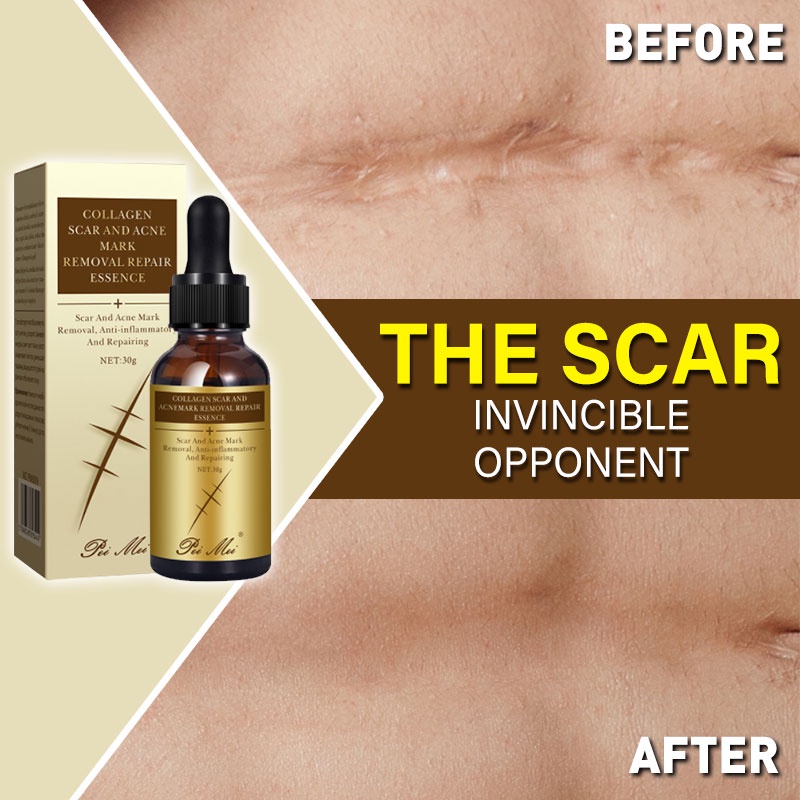 Scar Remover Peklat Scarminator Cream Strech Mark Remover Pimple for