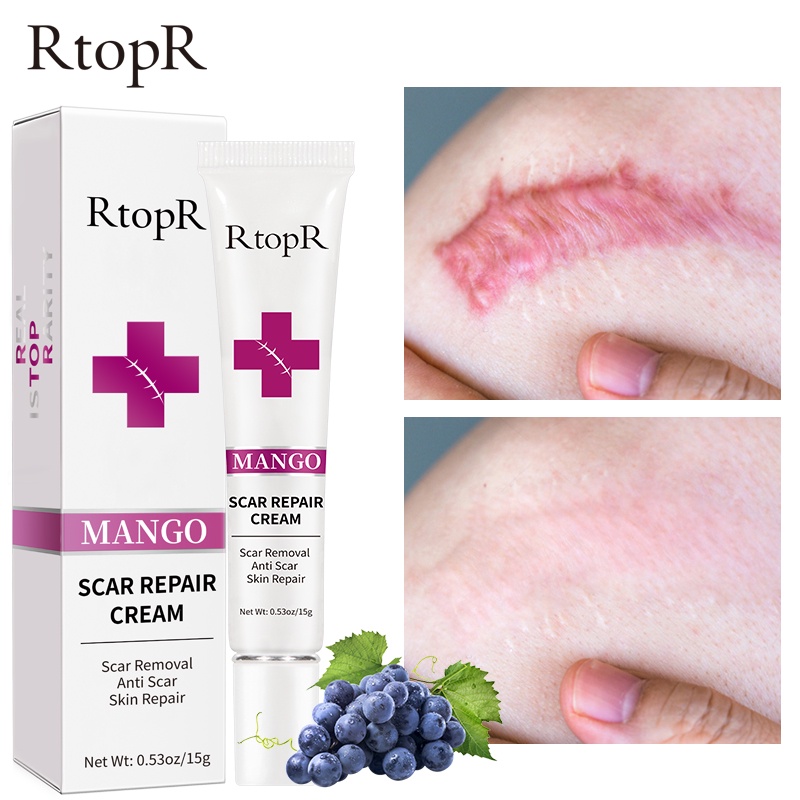 RtopR Scar Removal Cream Acne Scar Treatment Face Cream Body Skin Care Scar Remover Spots