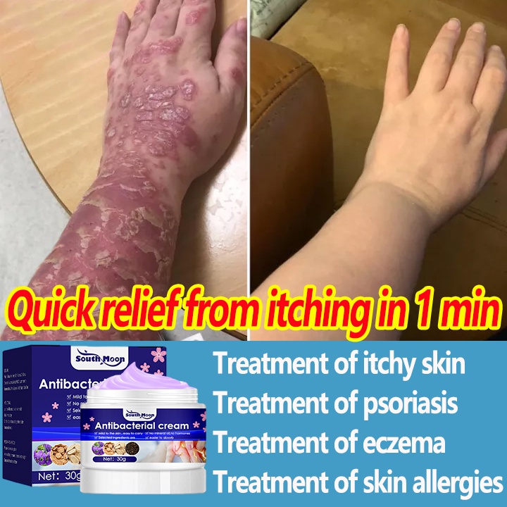 Eczema Cream Effective Itching Sweat Herpes Treatment Ointment for