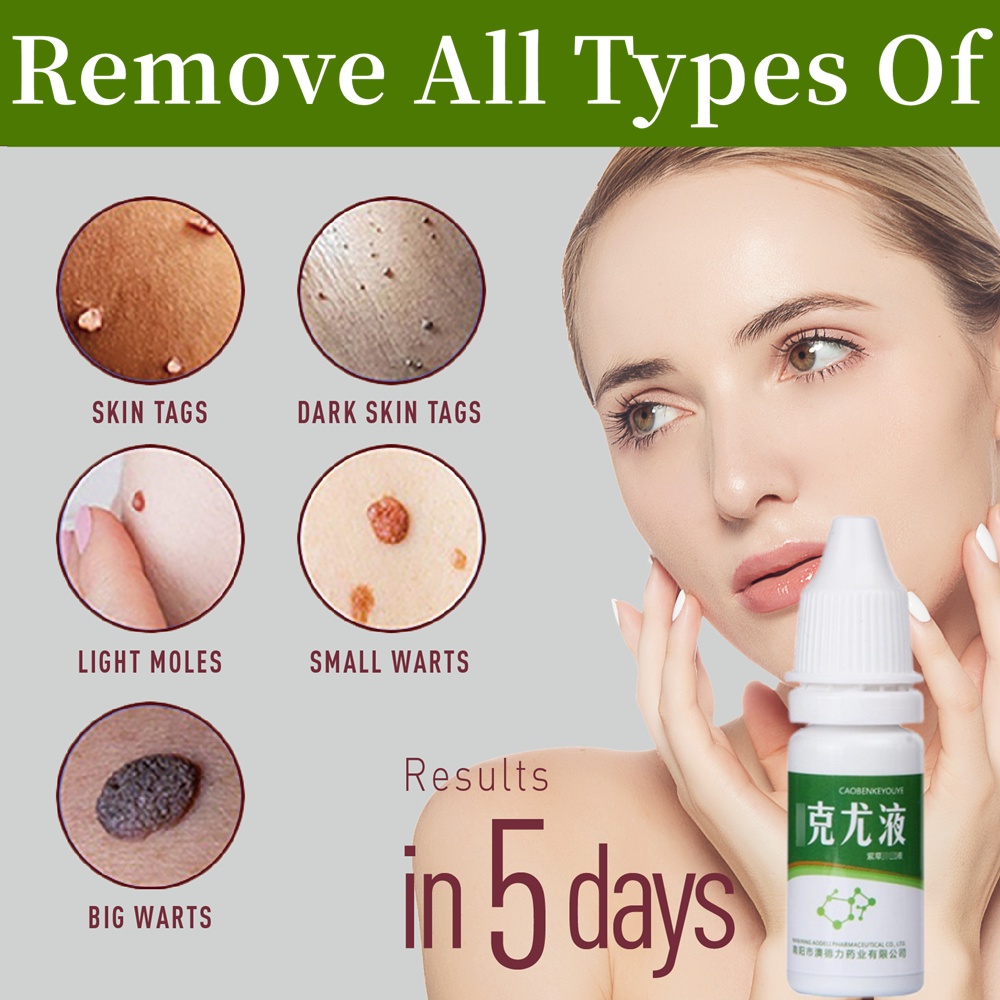 10ML Warts Remover Liquid Remove Foot corns Mole Skin Tags Get Rid Of