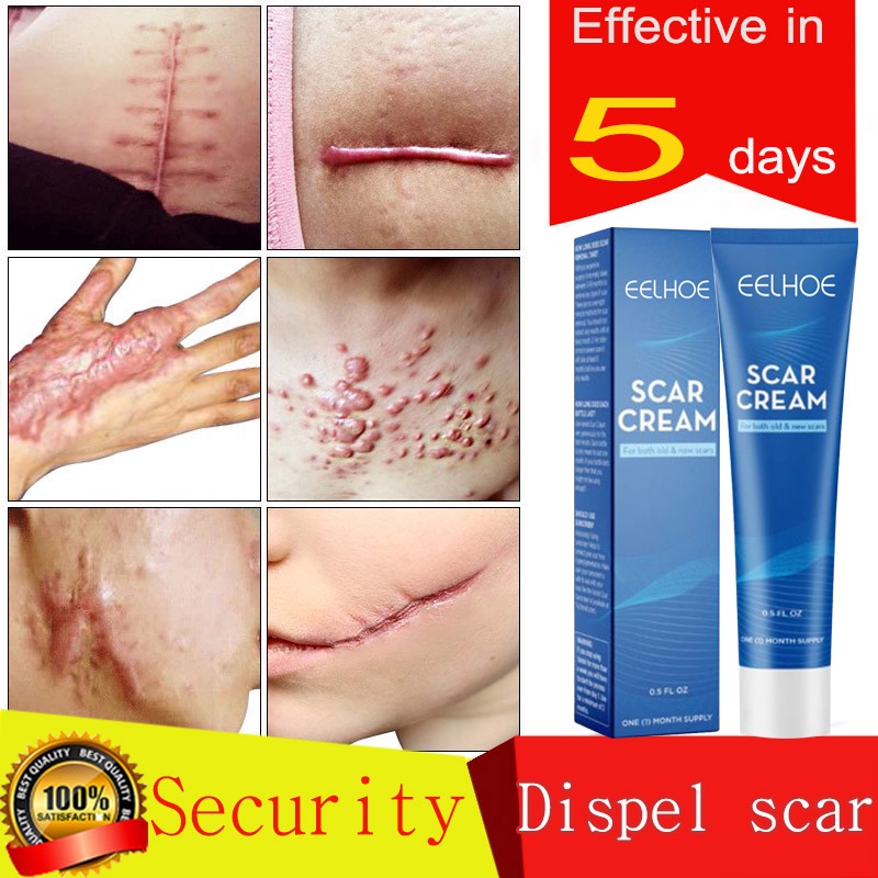 Scar Remover Cream Old Scar On Legs Face Body Scar Original Stretch
