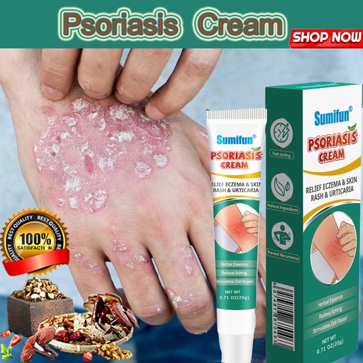 Psoriasis Cream Ointment Eczema Treatment For Eczema Allergy Ointment ...