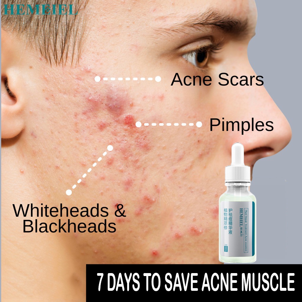 HEMEIEL Acne Treatment Serum, Adapalene, Pimple Remover, Anti Acne