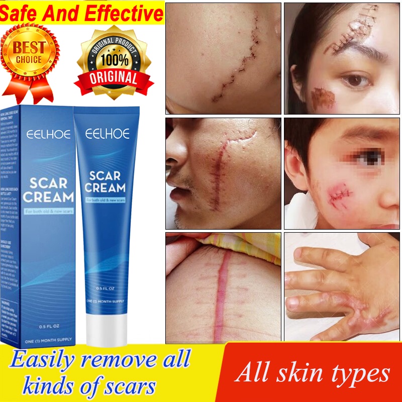 Scar Remover Cream Skin Repair Cream Desalinate Scar Burn Surgical ...