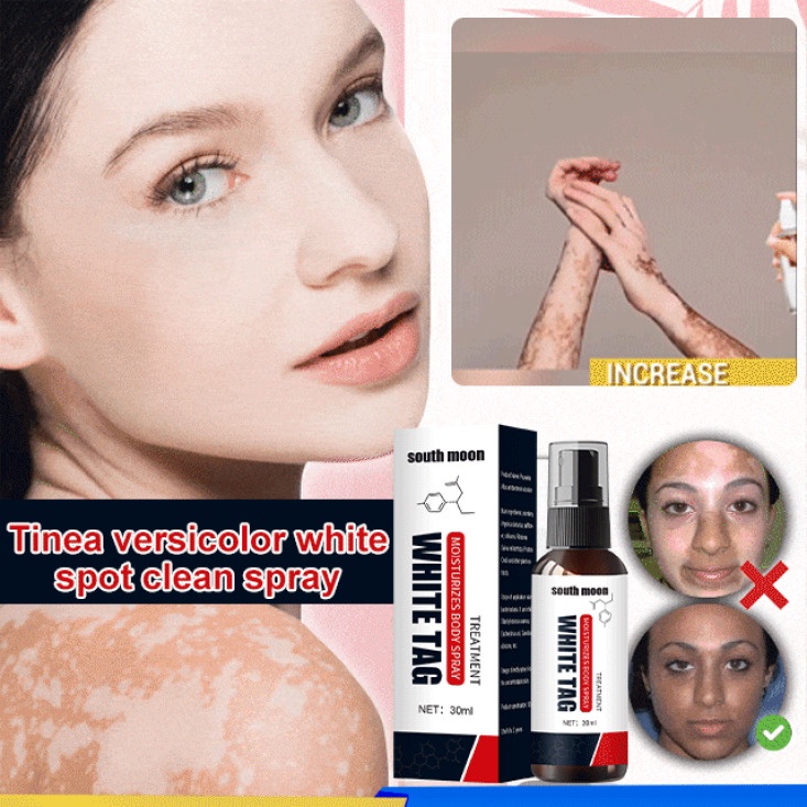Tinea Versicolor White Spot Vitiligo Clean Spray 30ml Shopee Philippines