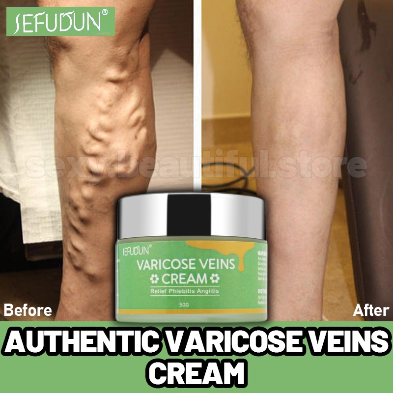 SEFUDUN Varicose Vein Remover Cream Effective Treatment Spider Vein