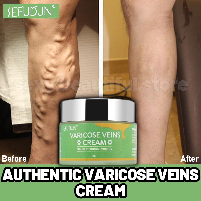 SEFUDUN Varicose Vein Remover Cream Effective Treatment Spider Vein ...