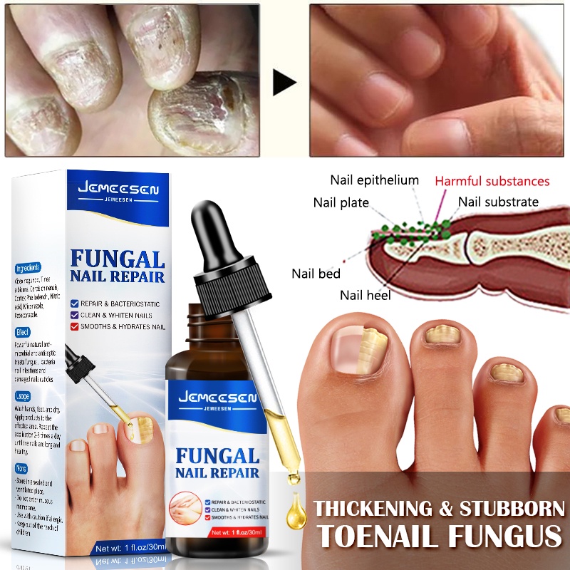 Jemeesen Fungal Nail Treatment Serum Foot Repair Essence Care Whitening