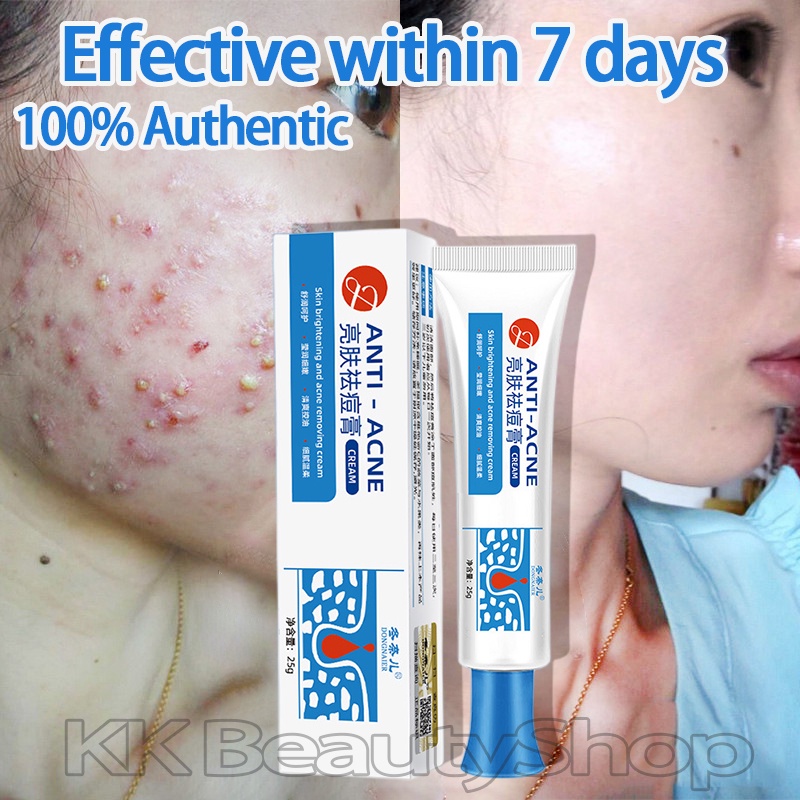 Anti-Acne Cream Pimple Scar Remover Cream Pekas Treatment Gel Skin Care ...