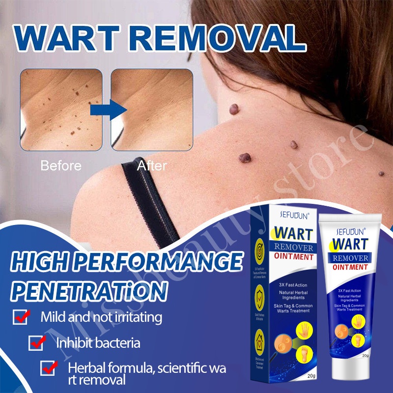 Warts Remover Cream Foot Corn Remover Cream Ointment Antibacterial