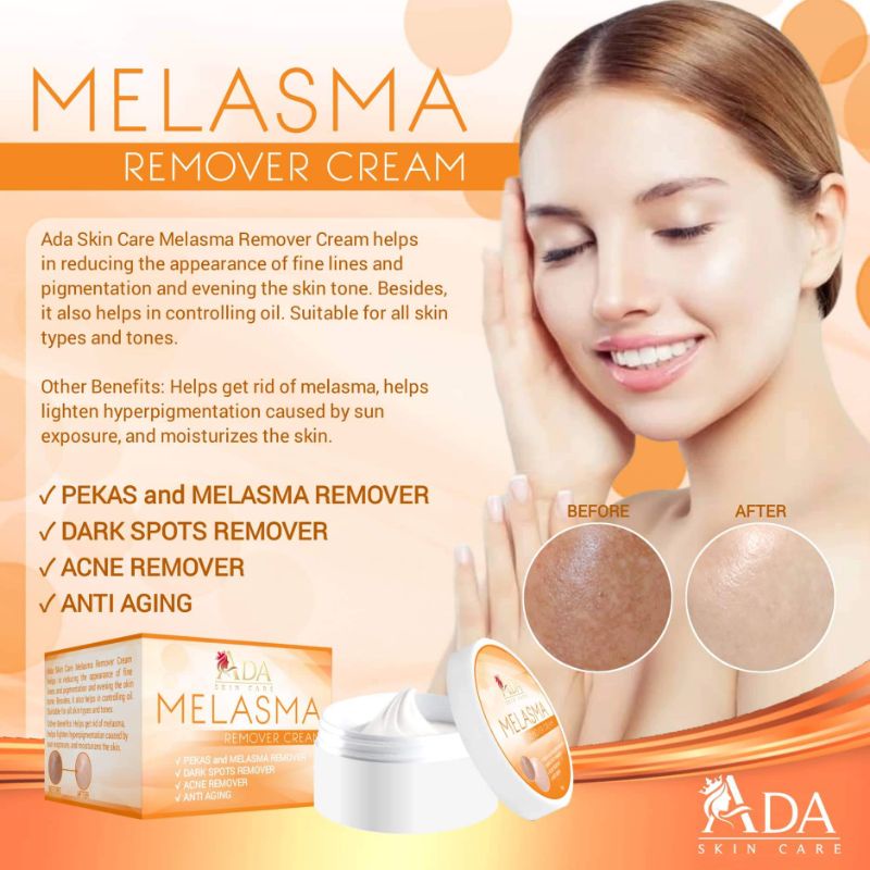 Melasma Remover Cream Shopee Philippines