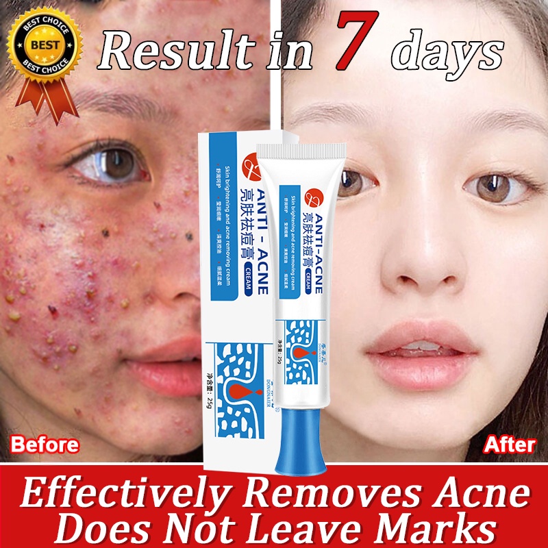 Acne Cream Pimple Remover Cream Acne Remover Pimple Scar Remover Acne