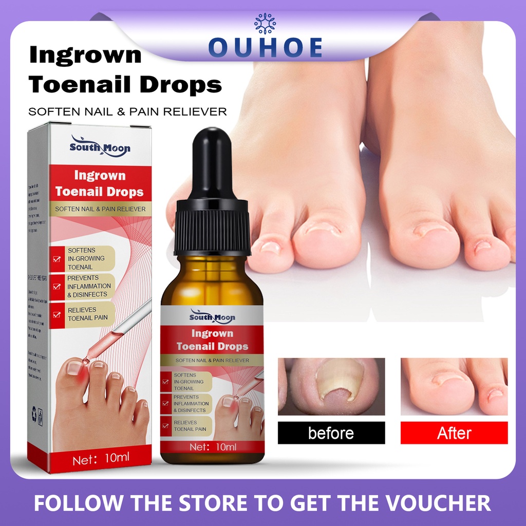 Ingrown toenail remover Treatment Softener Essential Oil Ingrown