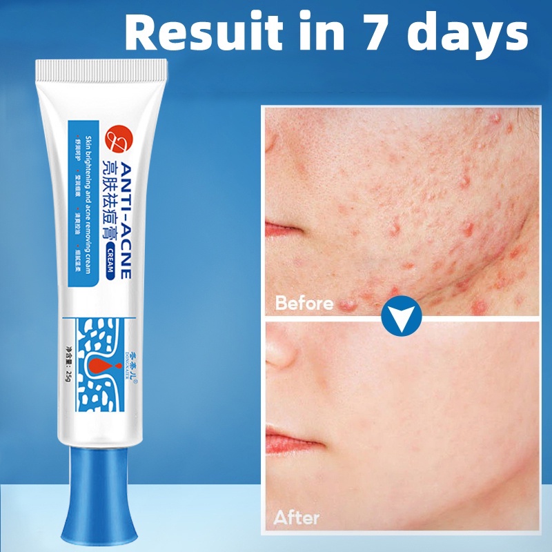 Acne Remover Cream Acne Treatment Skin Repair Pimple Marks Remover Acne