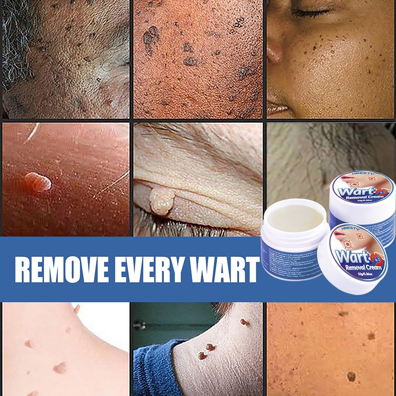 HBESTY Painless Warts Remover Original Cream Medical Mole Remover ...