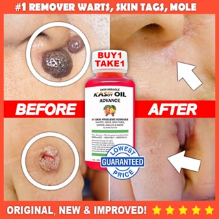 No.1 Remover: Warts/Kulugo, Skin tag, Mole/Nunal, Callus/Kalyo, More[BEST PRODUCT 2022] BUY 1 TAKE 1