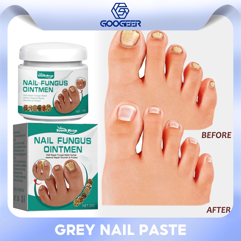 South Moon Nail Fungus Ointmen Treatment Repair Essence Nail Anti