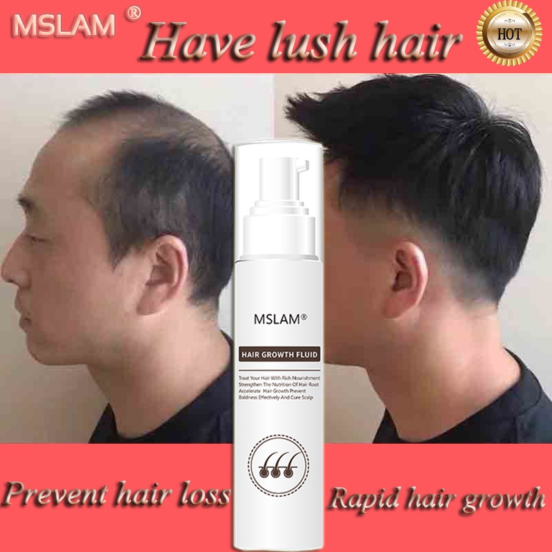 CASNER Hair growth fluid Hair Growth Spray Hair growth essential oil