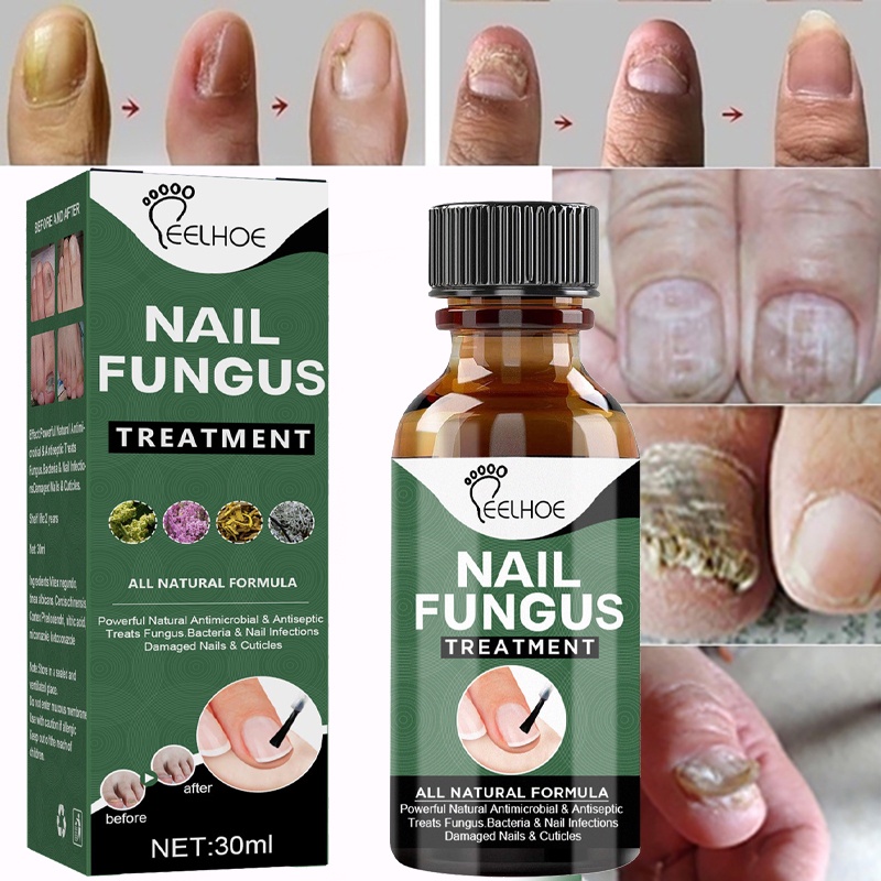 Antibacterial Nail Treatments Essential Extract Nail Fungus Serum ...