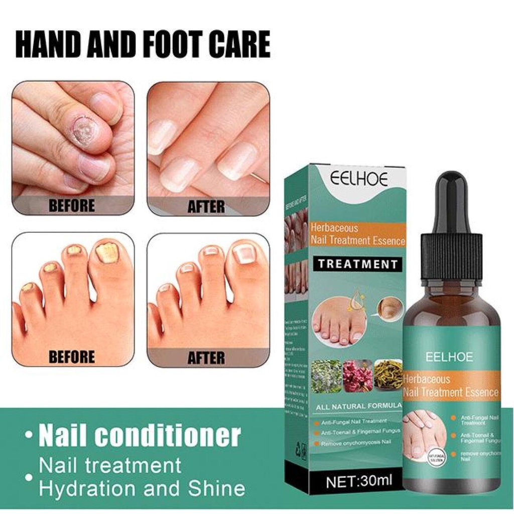 Paronychia repair solution Onychomycosis repair solution Bump nail care ...