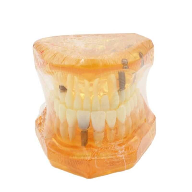 Implant Teeth With Restoration Bridge Tooth Dentist Disease Teaching ...